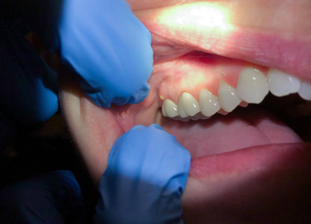 Best Emergency Dental Care for Broken or Chipped Teeth in Mount Vernon, MD